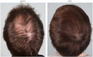 Top Myths and Facts About PRP Hair Loss Treatment - La Fameux Derma