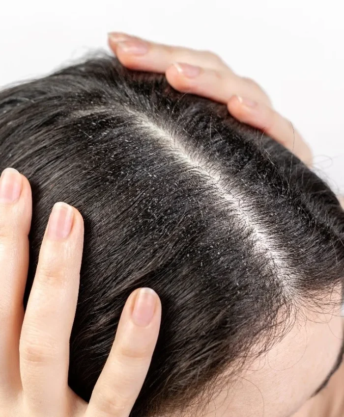 Dry Scalp and Hair Loss: Causes, Treatment, and Prevention